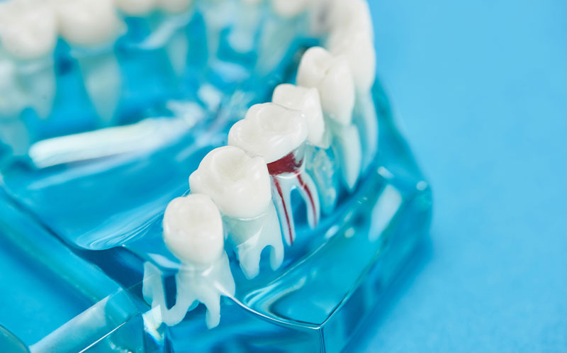 根管治療（歯内療法）